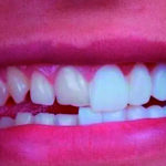 Facetas Dentárias: Saúde, Estética e Naturalidade com a Experiência da Dra. Patrícia Bobato