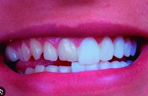 Facetas Dentárias: Saúde, Estética e Naturalidade com a Experiência da Dra. Patrícia Bobato